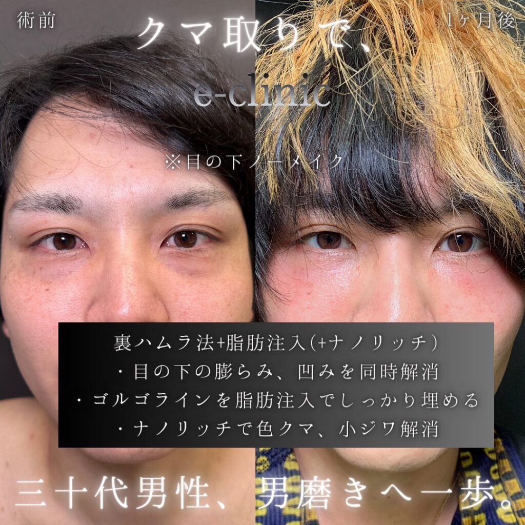 裏ハムラ法と脂肪注入の症例写真 (1)