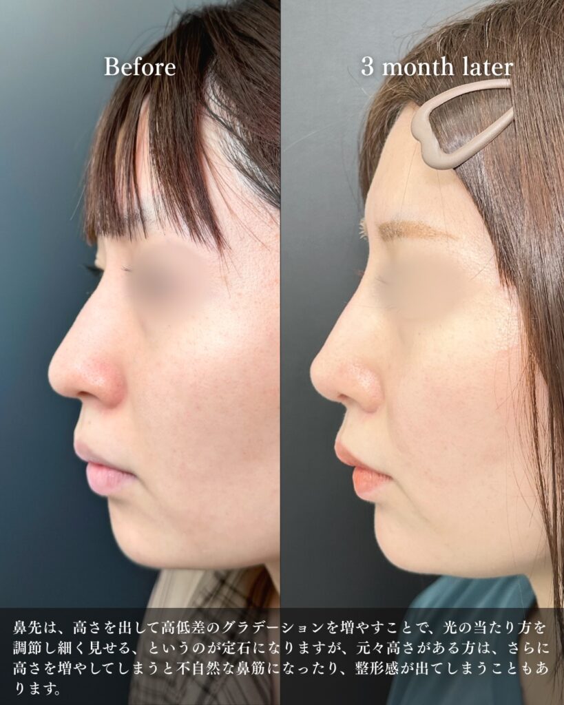 鼻尖形成と軟骨移植とプロテーゼと小鼻縮小の症例写真 (19)