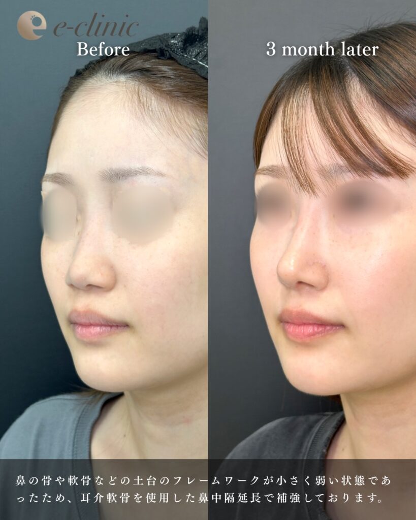 鼻中隔延長と鼻尖形成と軟骨移植とプロテーゼの症例写真 (13)