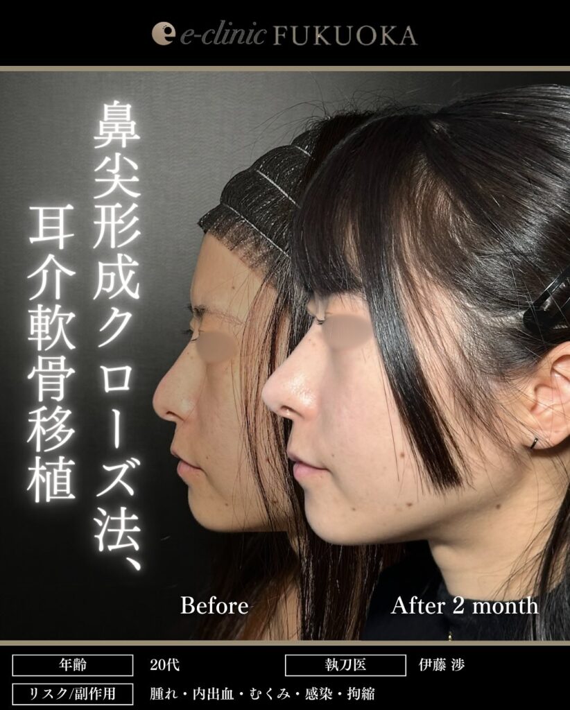 鼻尖形成と軟骨移植の症例写真 (23)