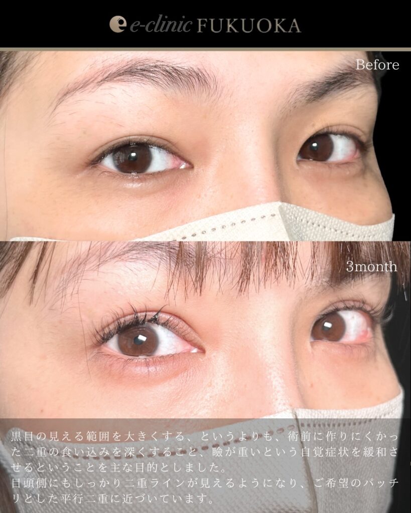 たるみとり併用全切開と眼瞼下垂と涙袋のヒアルロン酸の症例写真 (4)