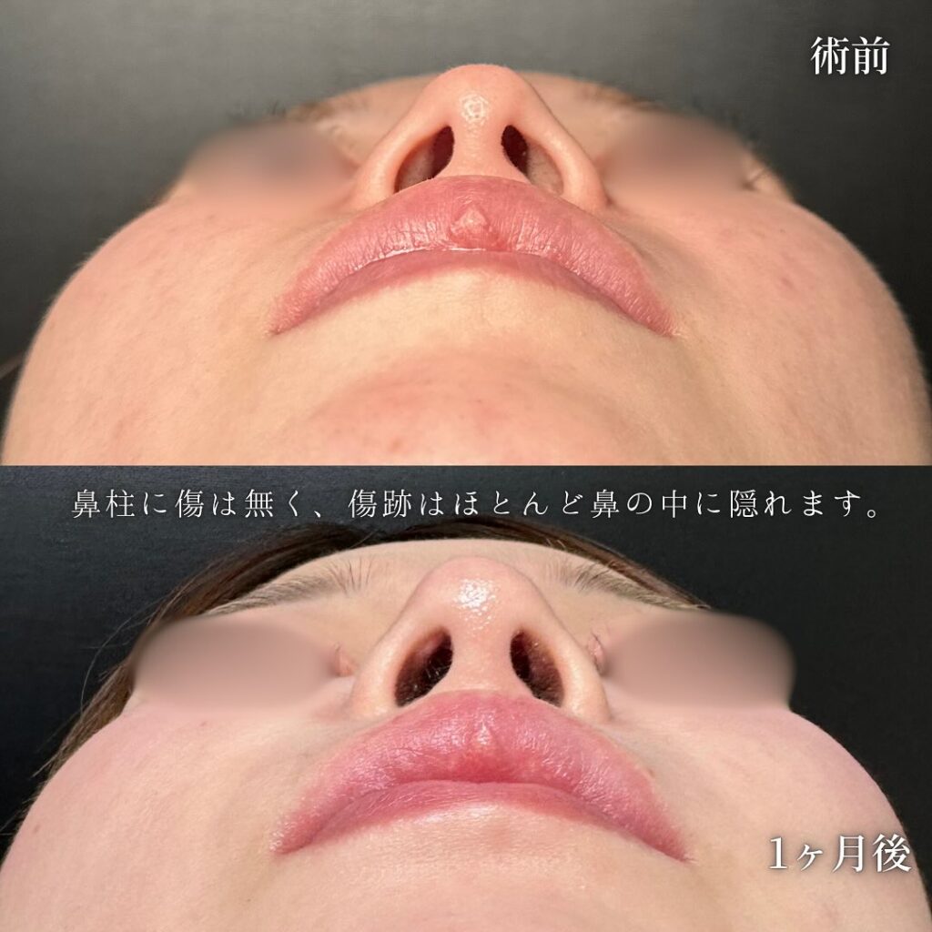 鼻尖形成と軟骨移植の症例写真 (6)