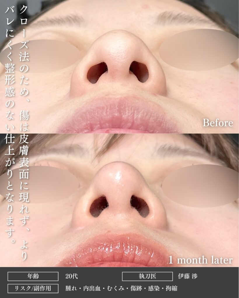 鼻尖形成と軟骨移植とプロテーゼの症例写真 (14)