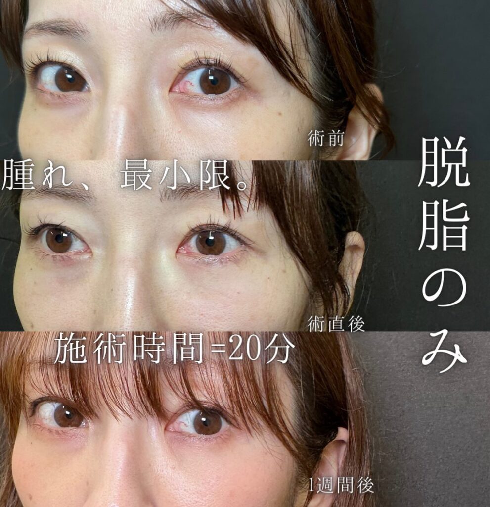 脱脂の症例写真 (3)