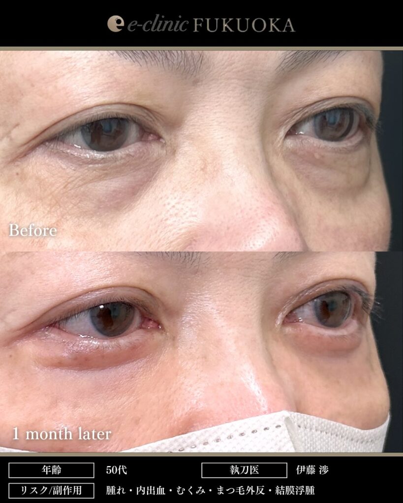 裏ハムラ法とナノリッチとボトックスの症例写真 (2)