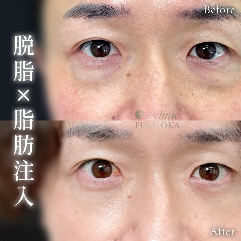 脱脂と脂肪注入の症例写真 (11)