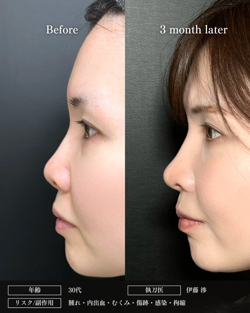 鼻尖形成と軟骨移植と小鼻縮小と裏ハムラ法と脂肪注入の症例写真 (6)