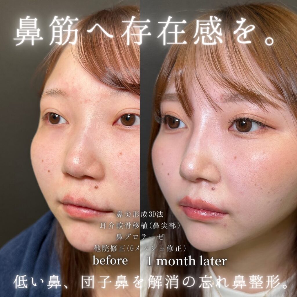 鼻尖形成と軟骨移植とプロテーゼと他院修正の症例写真 (1)