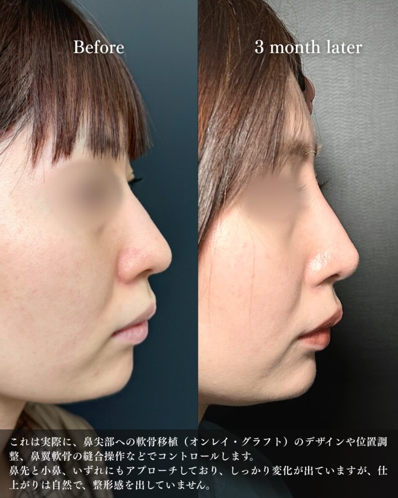 鼻尖形成と軟骨移植とプロテーゼと小鼻縮小の症例写真 (18)