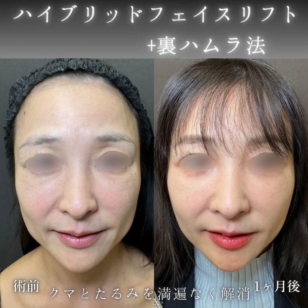 ハイブリットフェイスリフトと裏ハムラ法の症例写真 (1)
