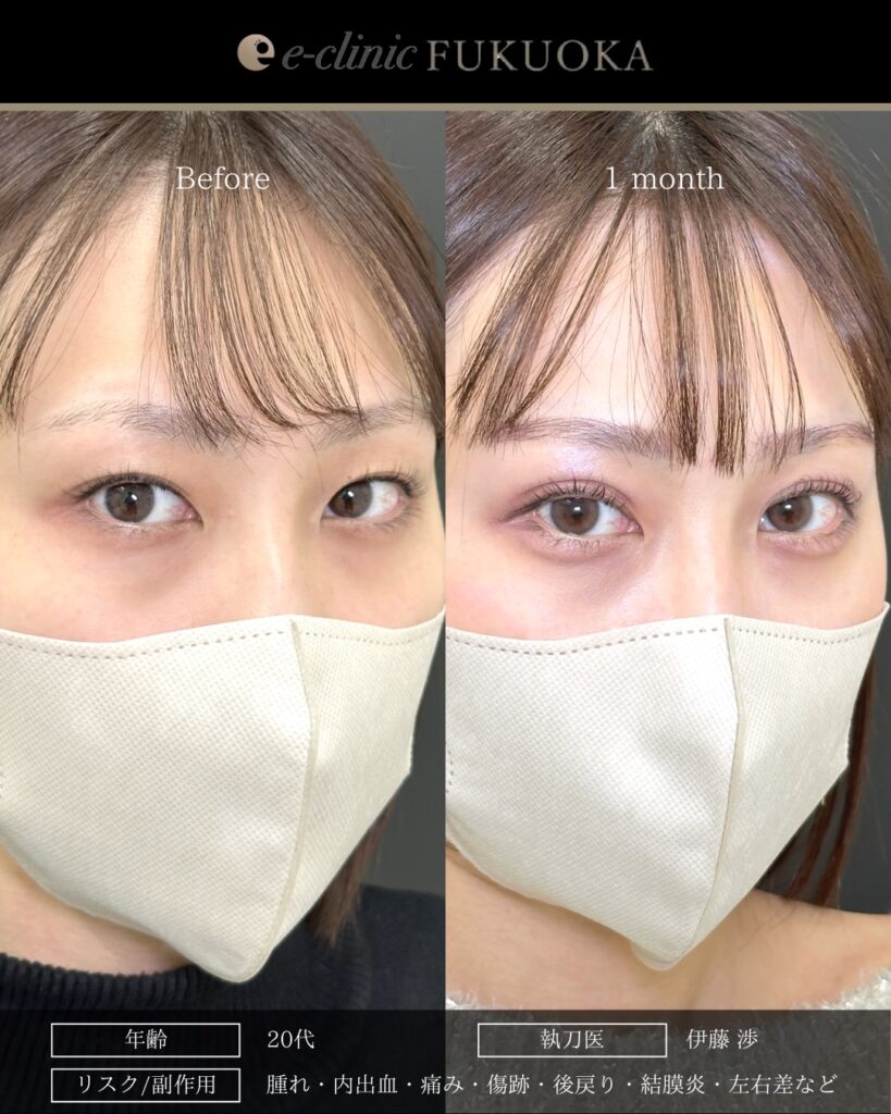 埋没法の症例写真 (14)