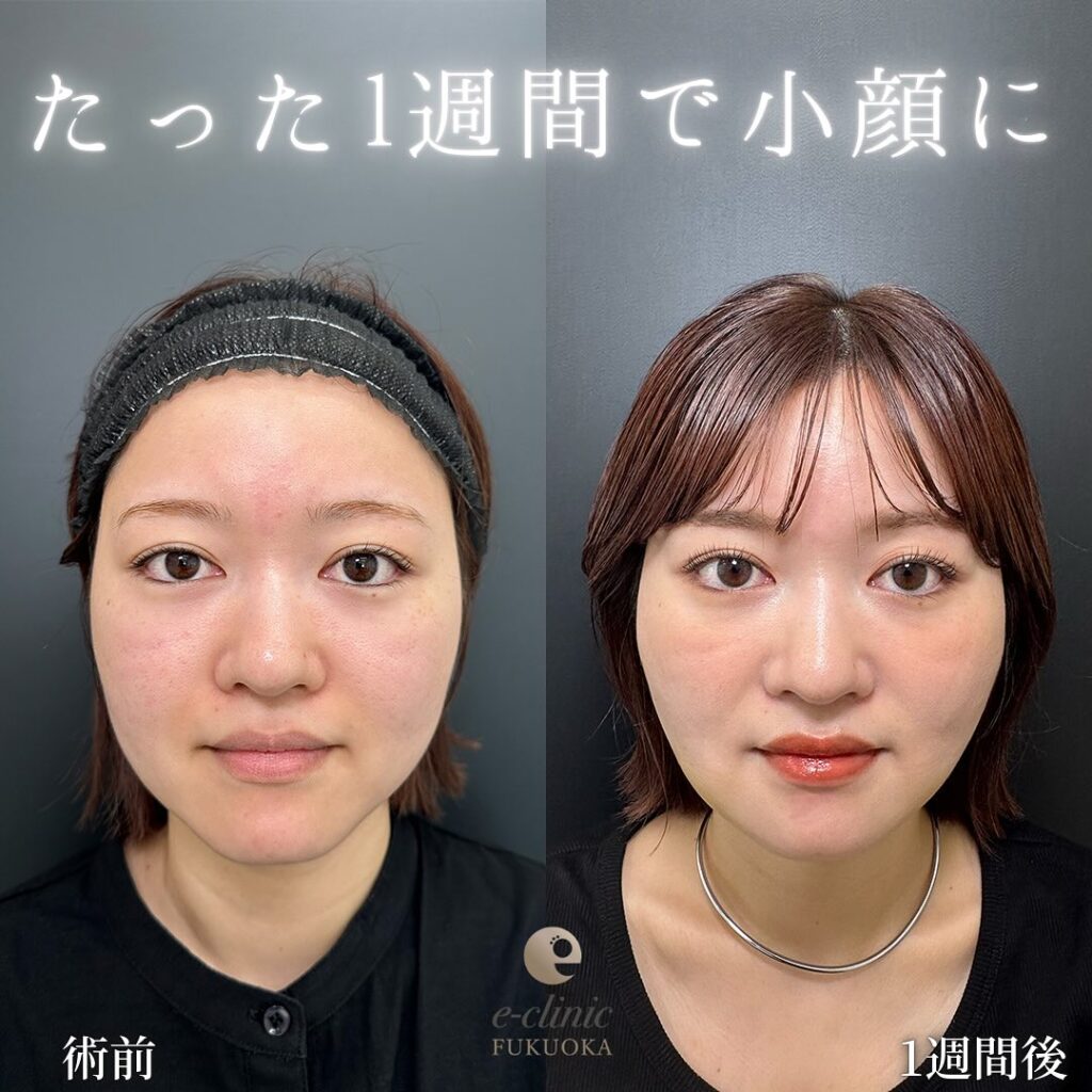 頬の脂肪吸引とジュールファットと糸リフトの症例写真 (1)