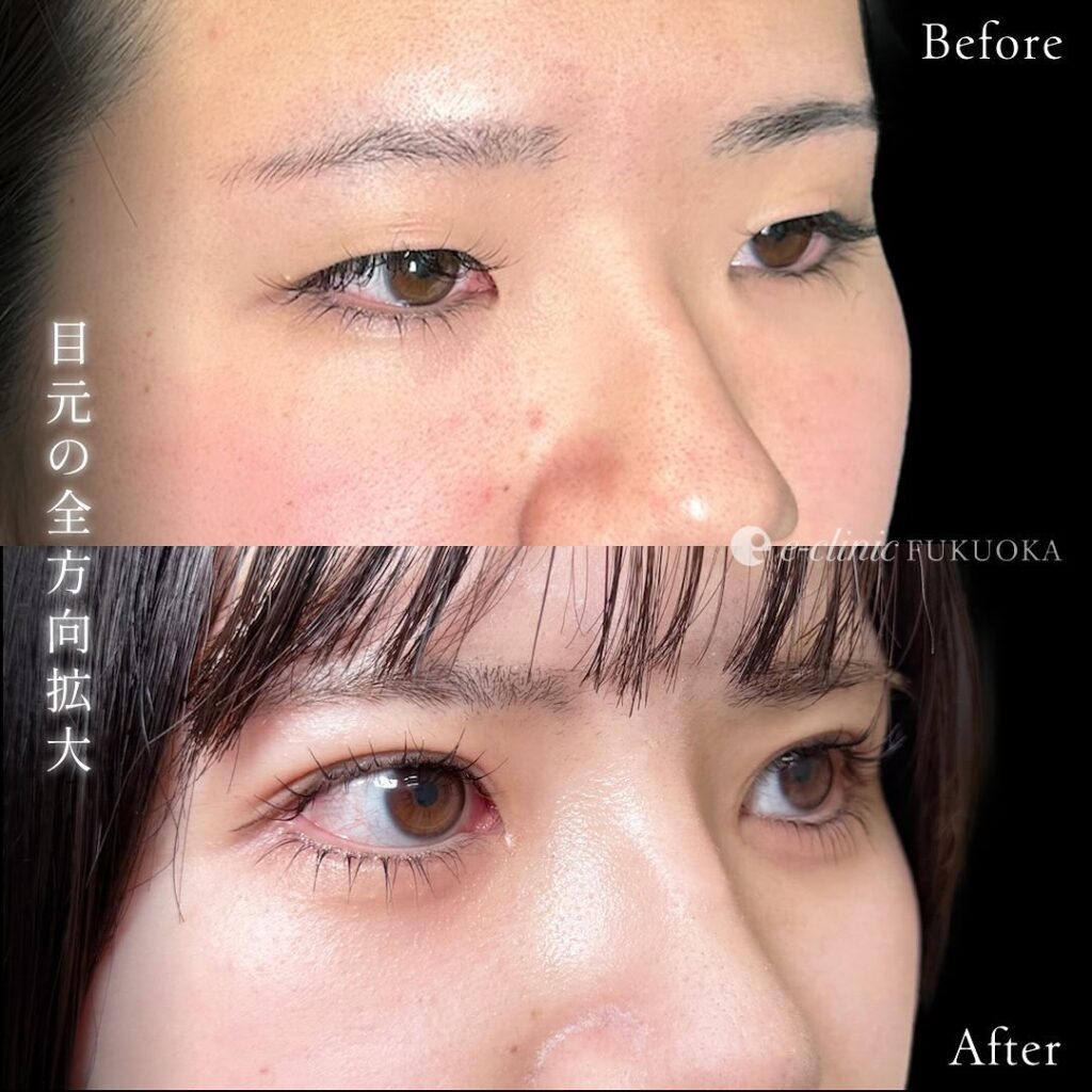 目元拡大の症例写真 (3)