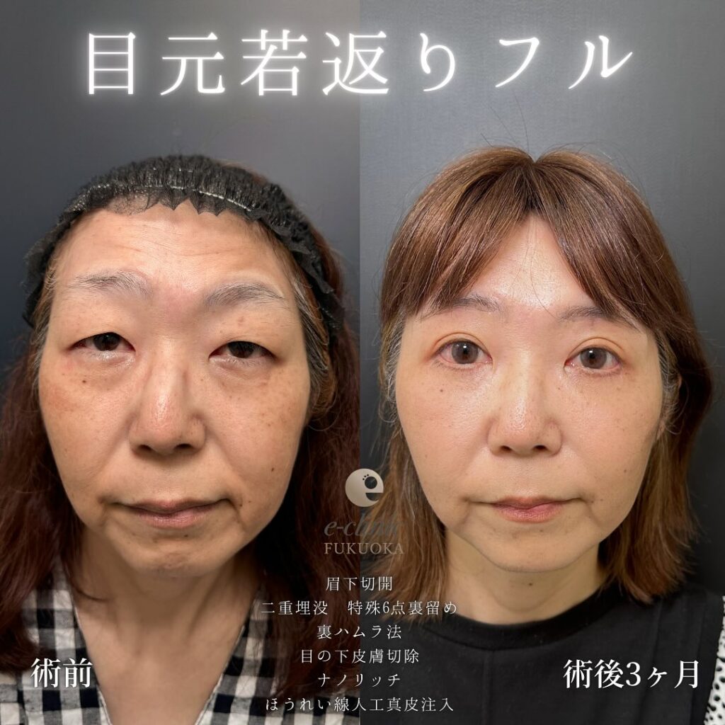 眉下切開と埋没法と裏ハムラ法と目の下の脂肪注入とほうれい線の脂肪注入の症例写真 (1)