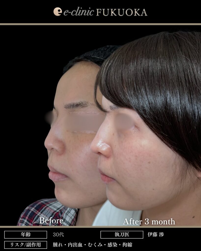 鼻尖形成と軟骨移植と小鼻縮小と鼻柱下降の症例写真 (2)