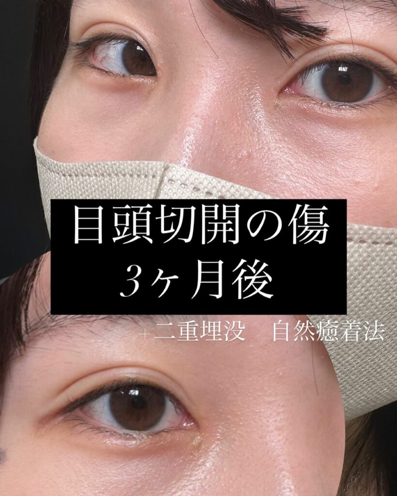 埋没法と目頭切開の症例写真 (6)