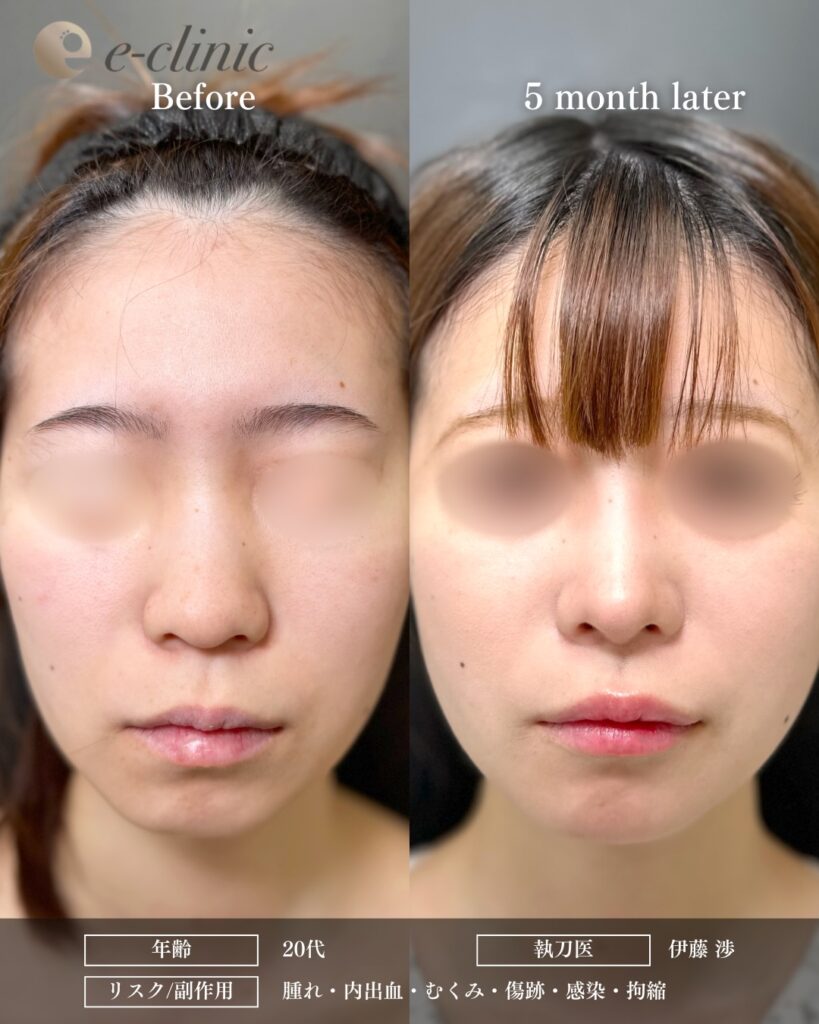 鼻尖形成と軟骨移植と鼻柱下降とプロテーゼの症例写真 (6)