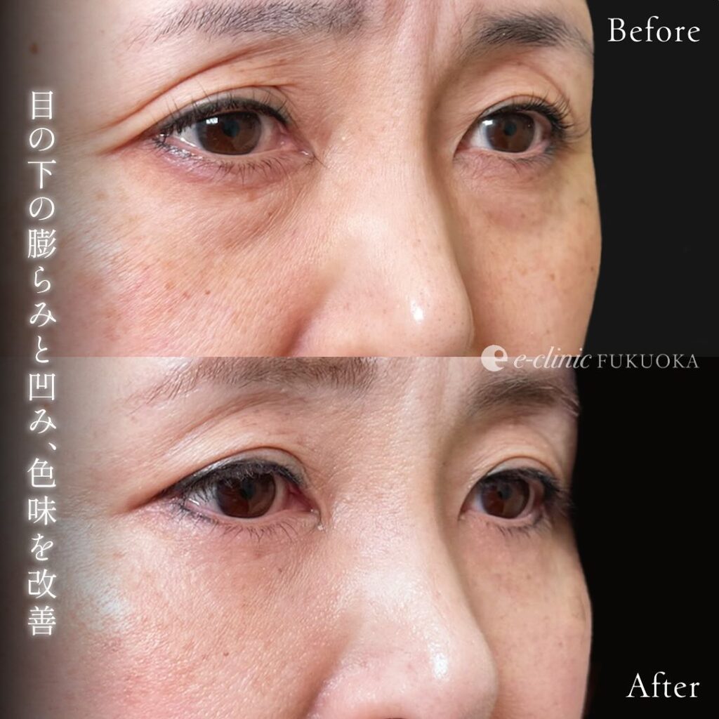 裏ハムラ法と目の下の脂肪注入と額とこめかみの脂肪注入の症例写真 (8)