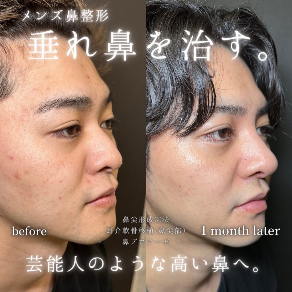 鼻尖形成と軟骨移植とプロテーゼの症例写真 (3)