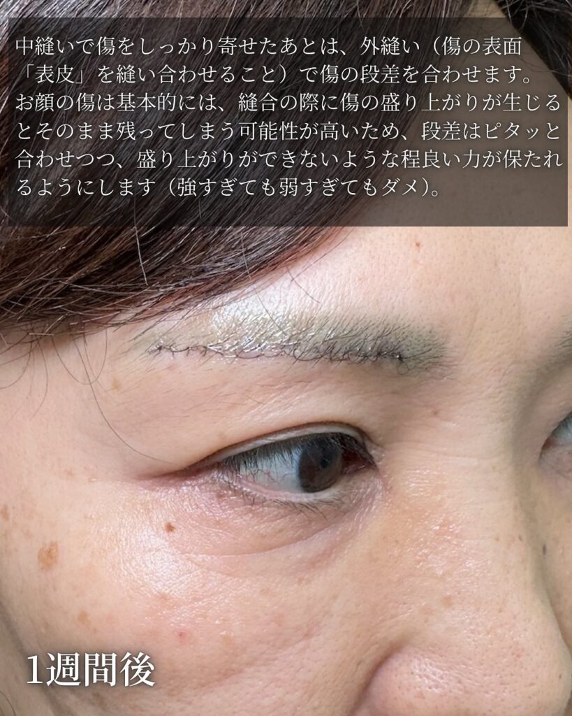 眉下切開の症例写真 (9)