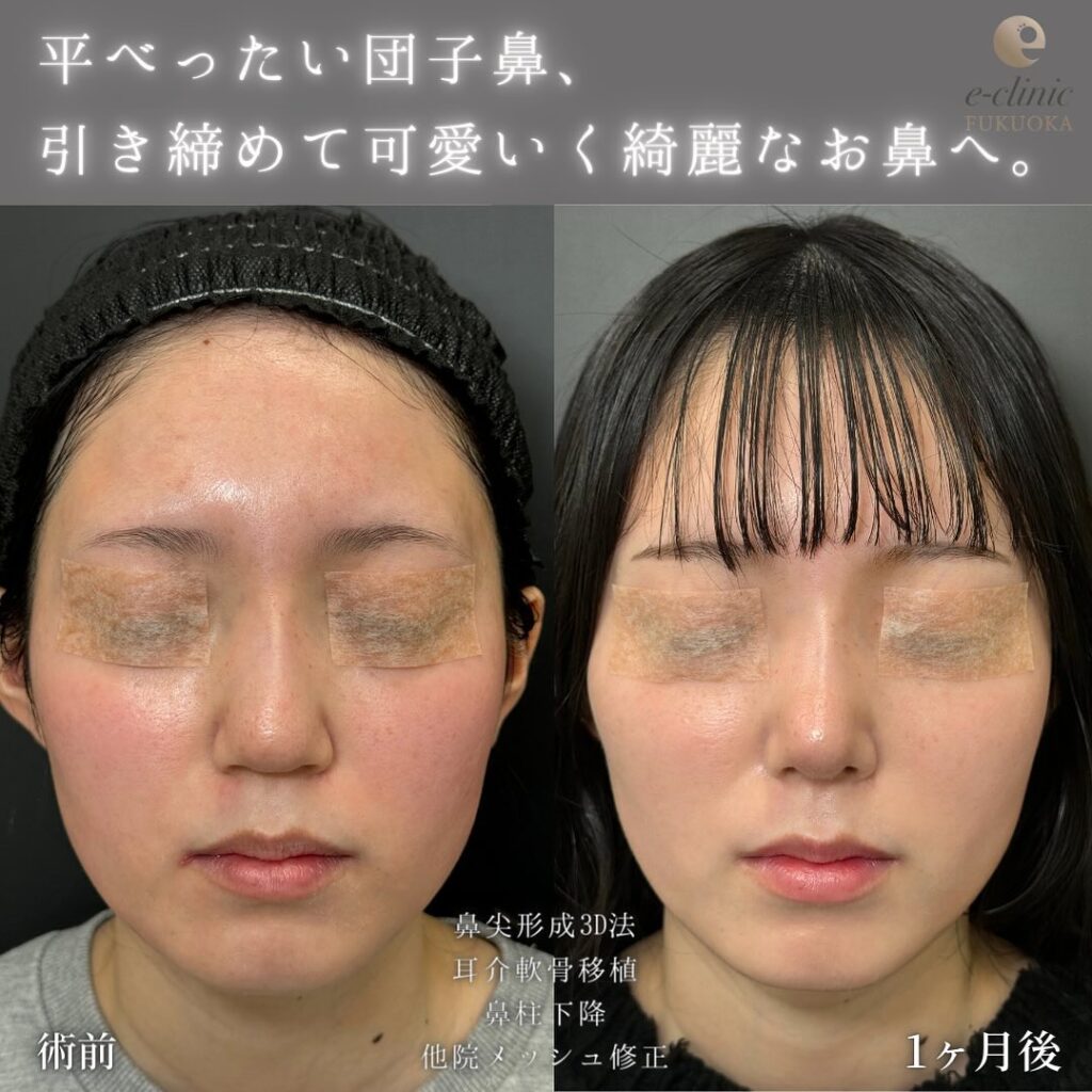 鼻尖形成と軟骨移植と鼻柱下降と他院修正の症例写真 (4)