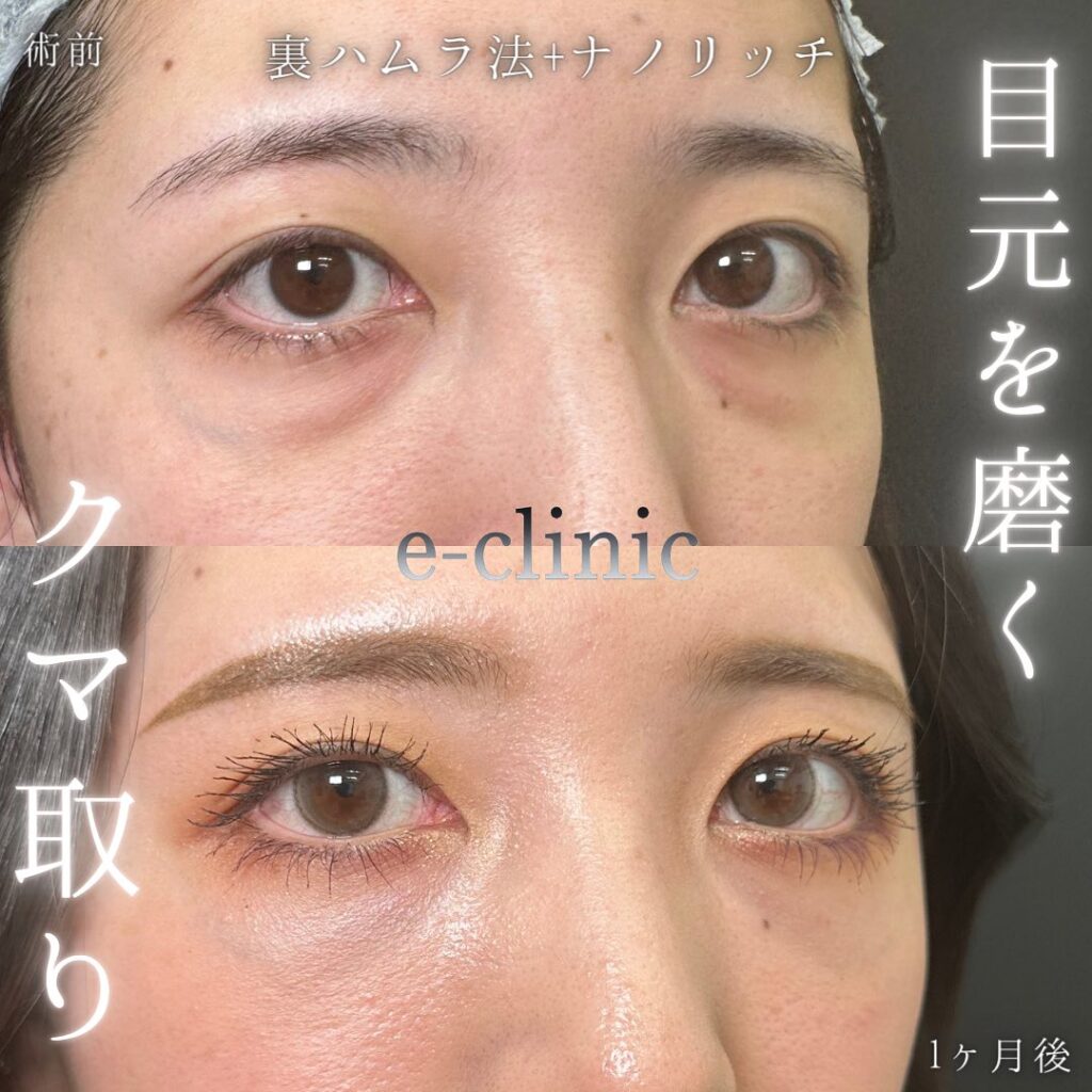 裏ハムラ法と脂肪注入の症例写真 (11)