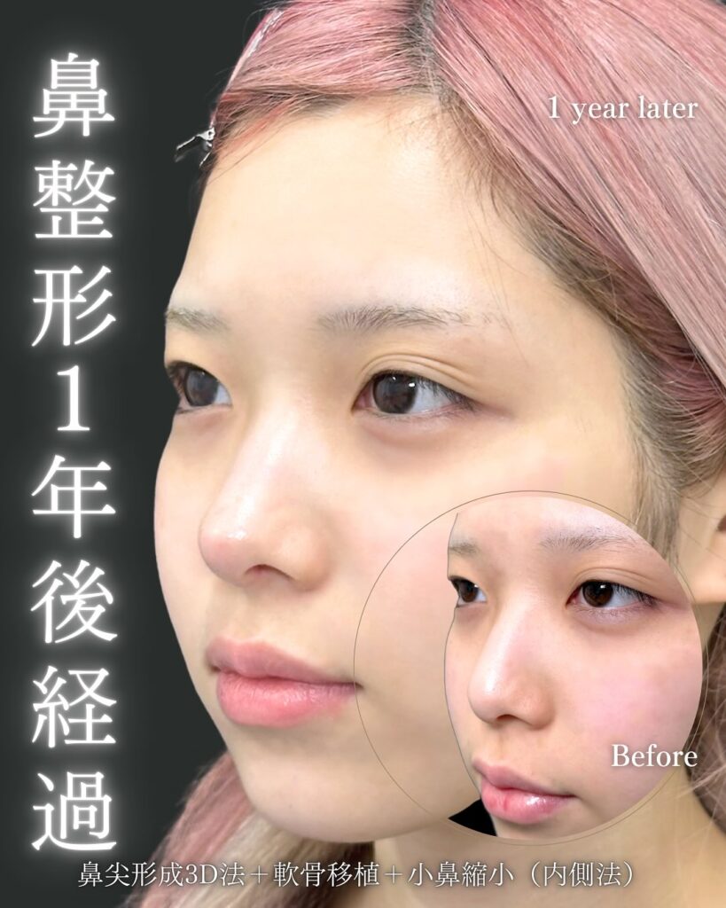 鼻尖形成と軟骨移植と小鼻縮小の症例写真 (31)