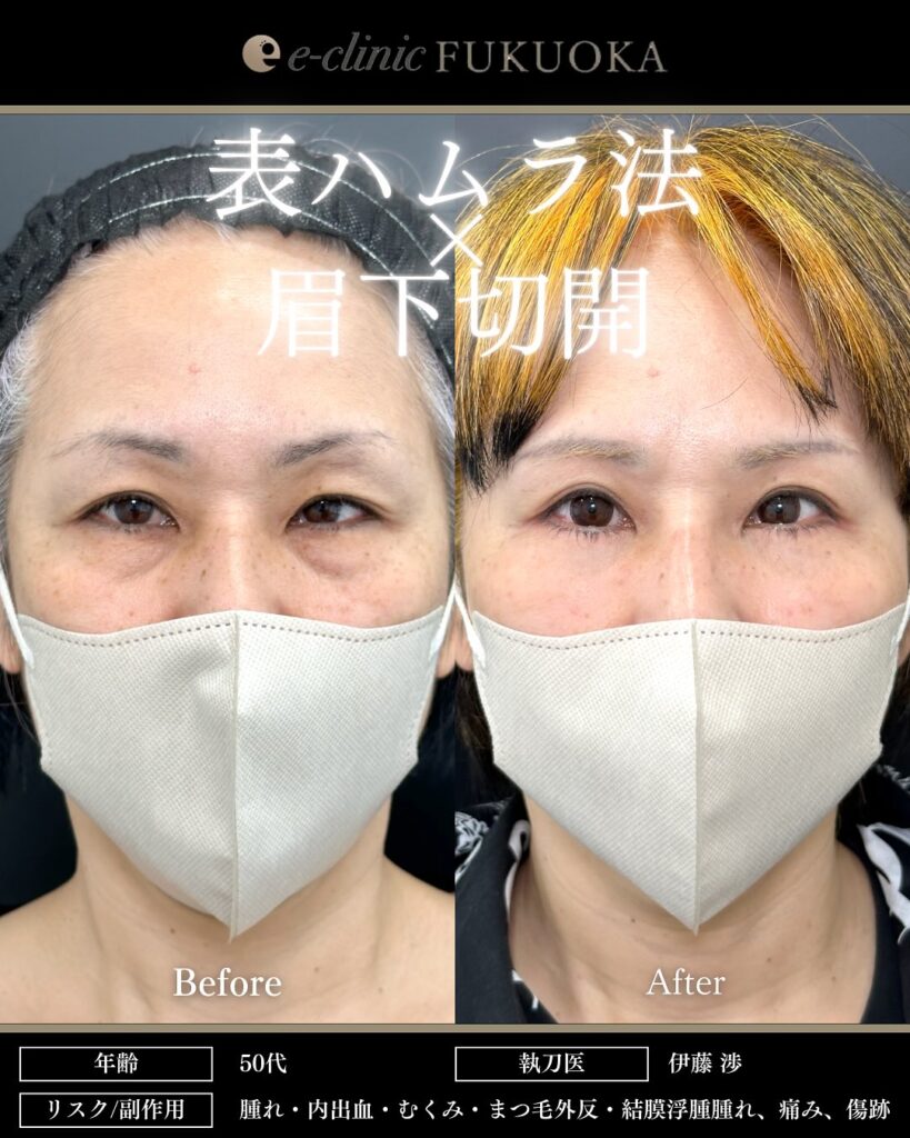 裏ハムラ法と眉下切開の症例写真 (1)