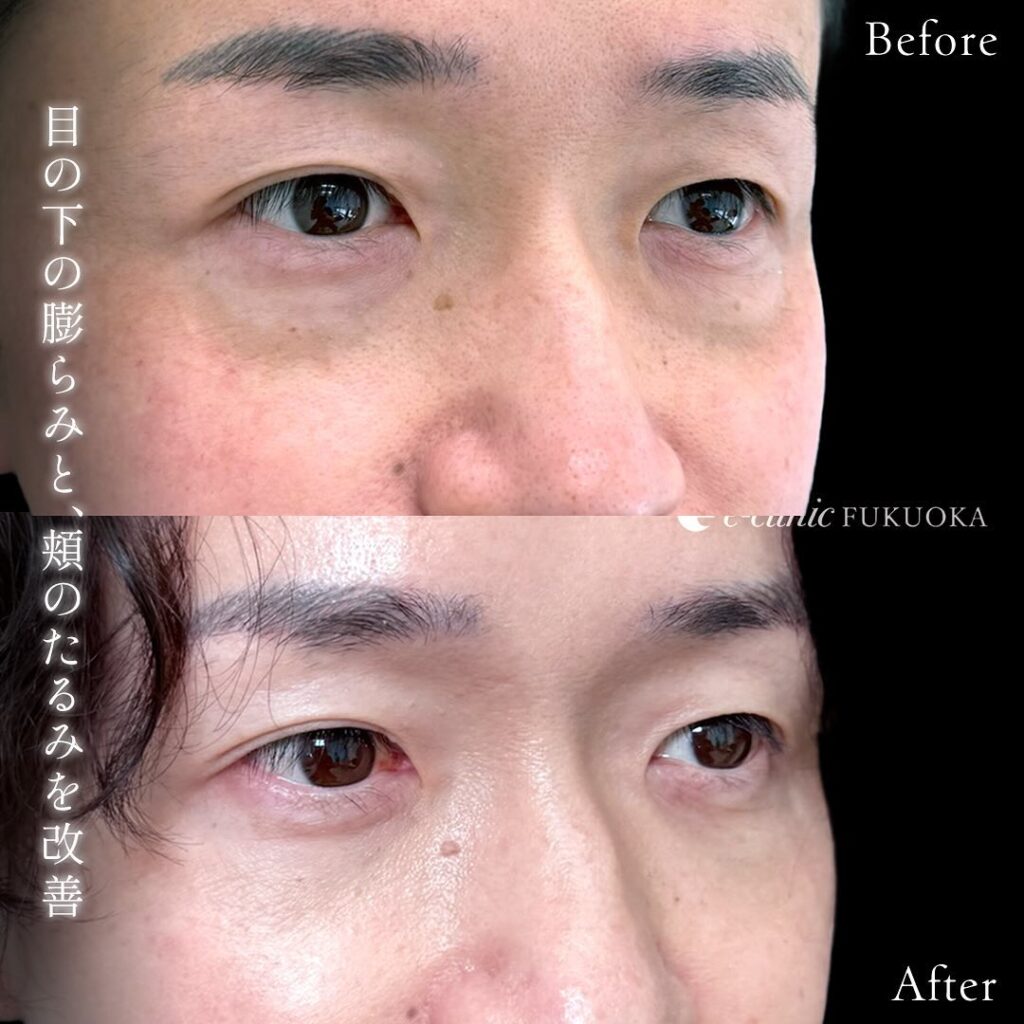 脱脂と脂肪注入の症例写真 (13)