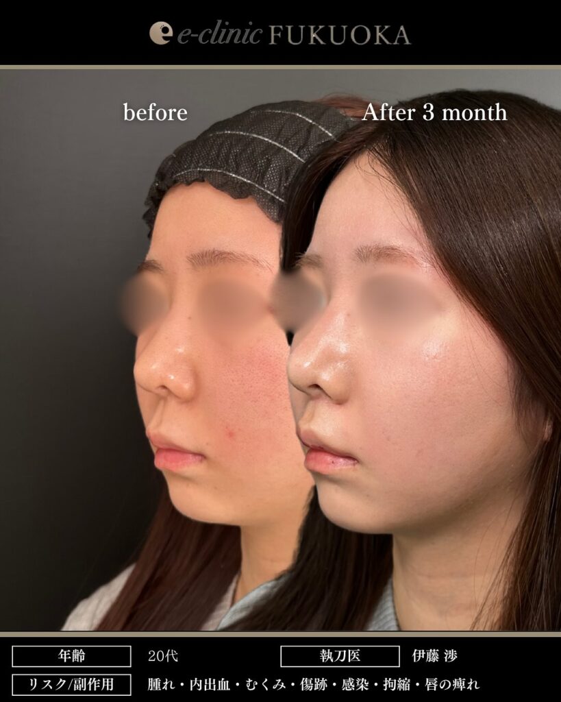 人中短縮の症例写真 (13)