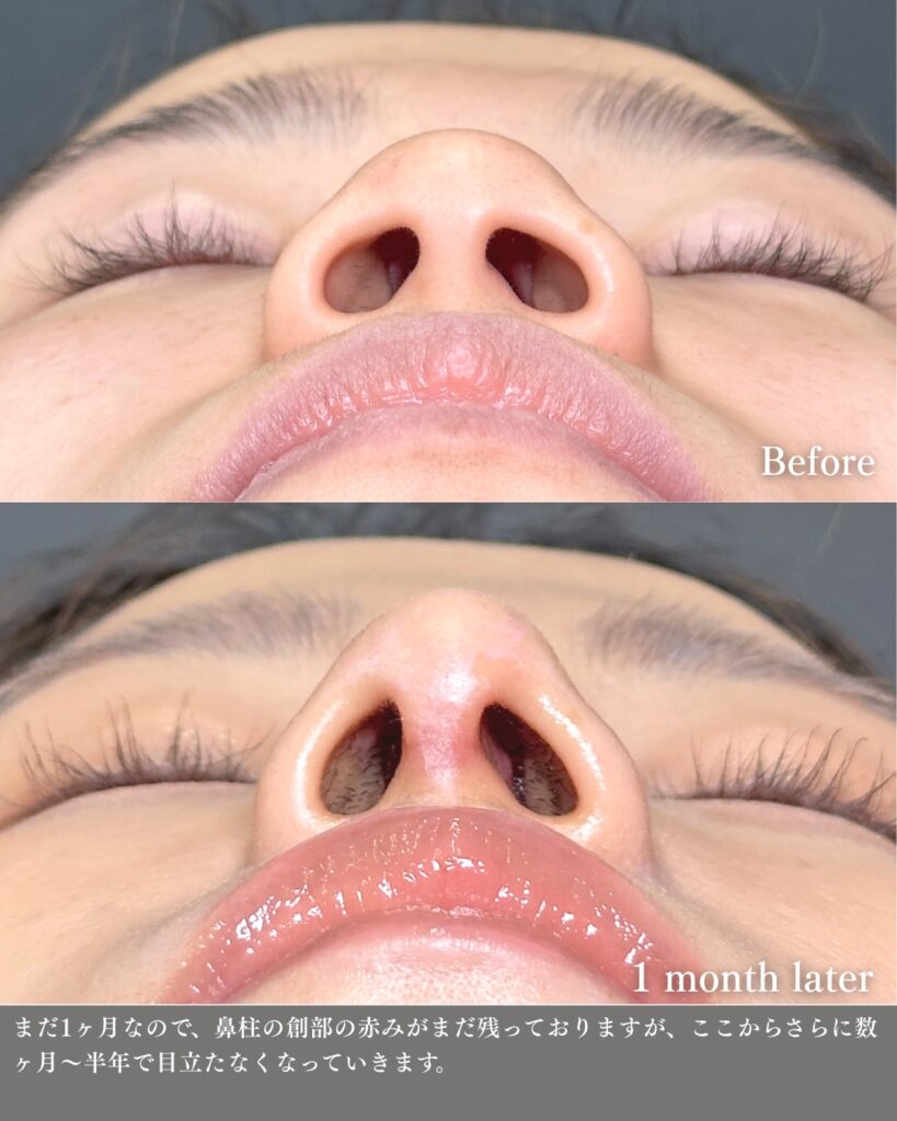 鼻中隔延長と鼻尖形成と軟骨移植と鼻柱下降とプロテーゼの症例写真 (4)