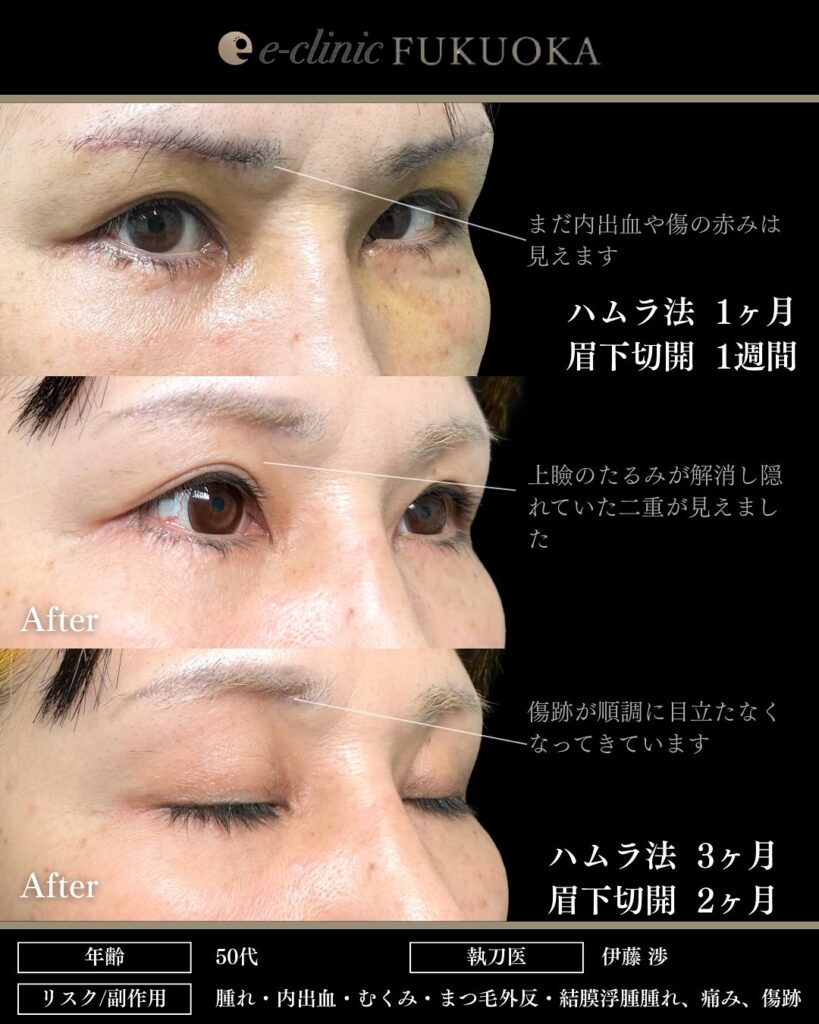 裏ハムラ法と眉下切開の症例写真 (5)