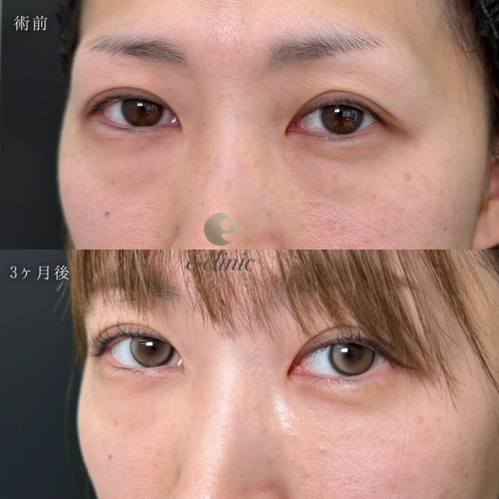 裏ハムラ法の症例写真 (63)