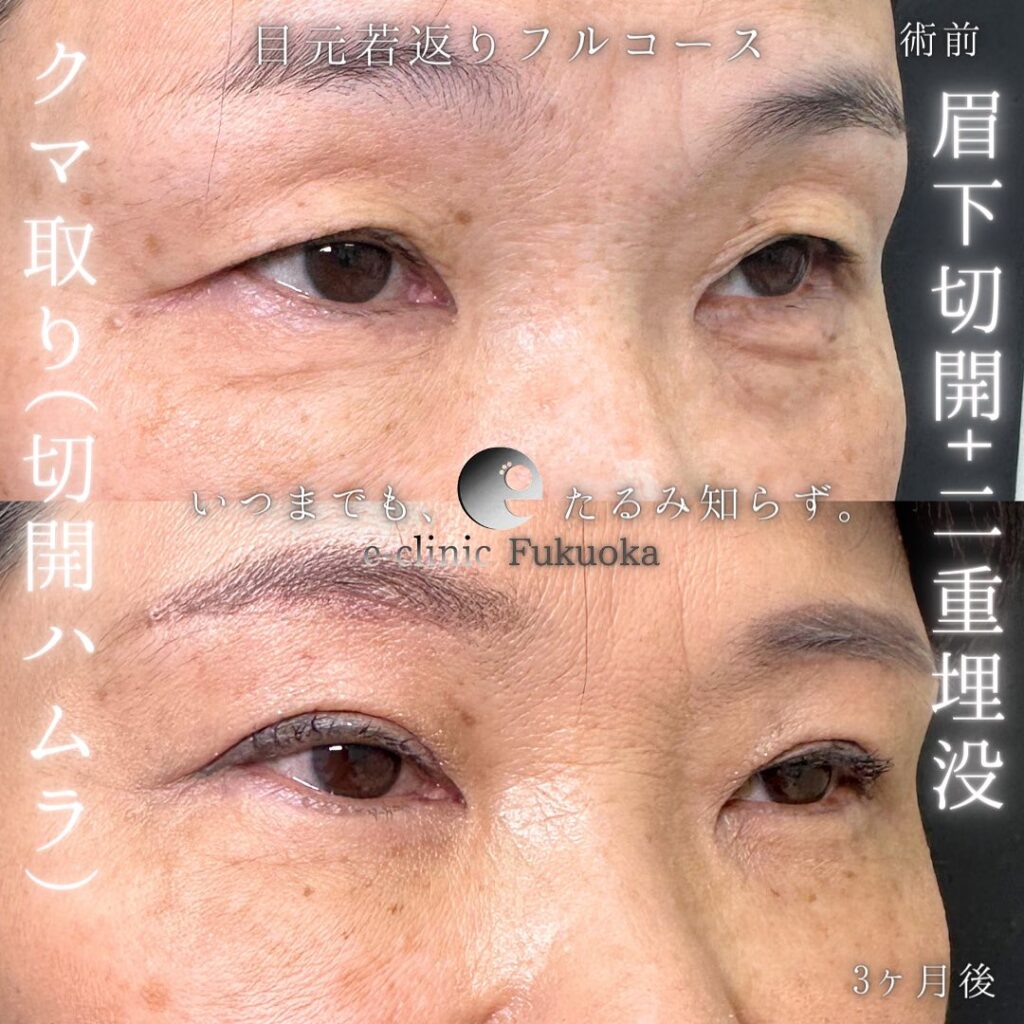 切開ハムラと眉下切開と埋没法の症例写真 (2)