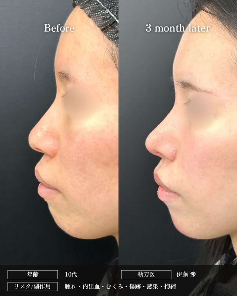 鼻尖形成と軟骨移植と小鼻縮小の症例写真 (38)