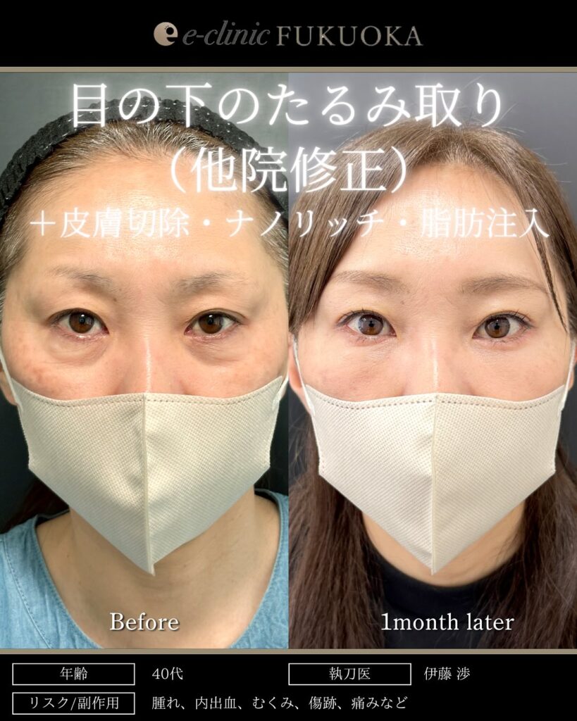 目の下のたるみ取りと脱脂と脂肪注入の症例写真 (1)