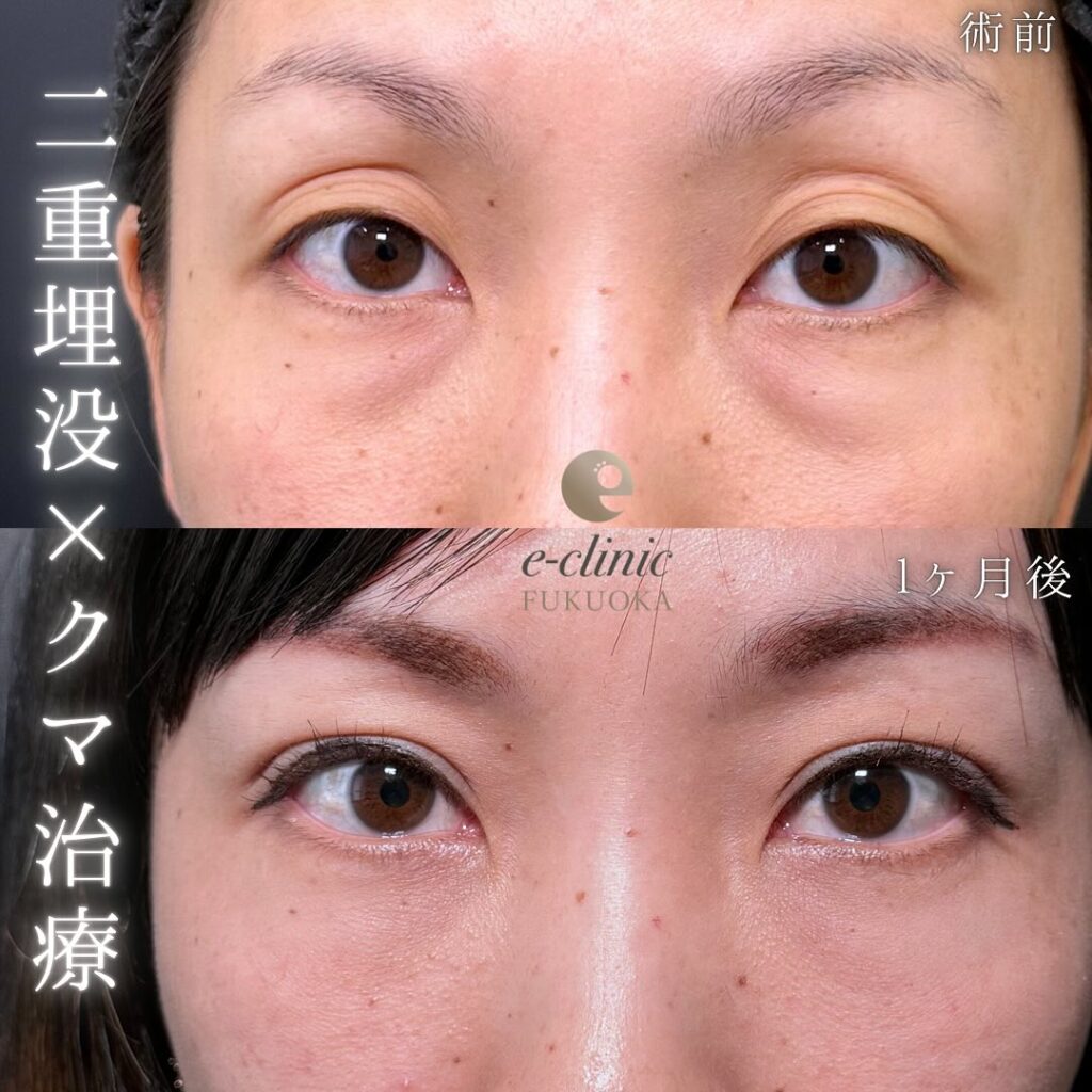 自然癒着法と裏ハムラ法の症例写真 (1)