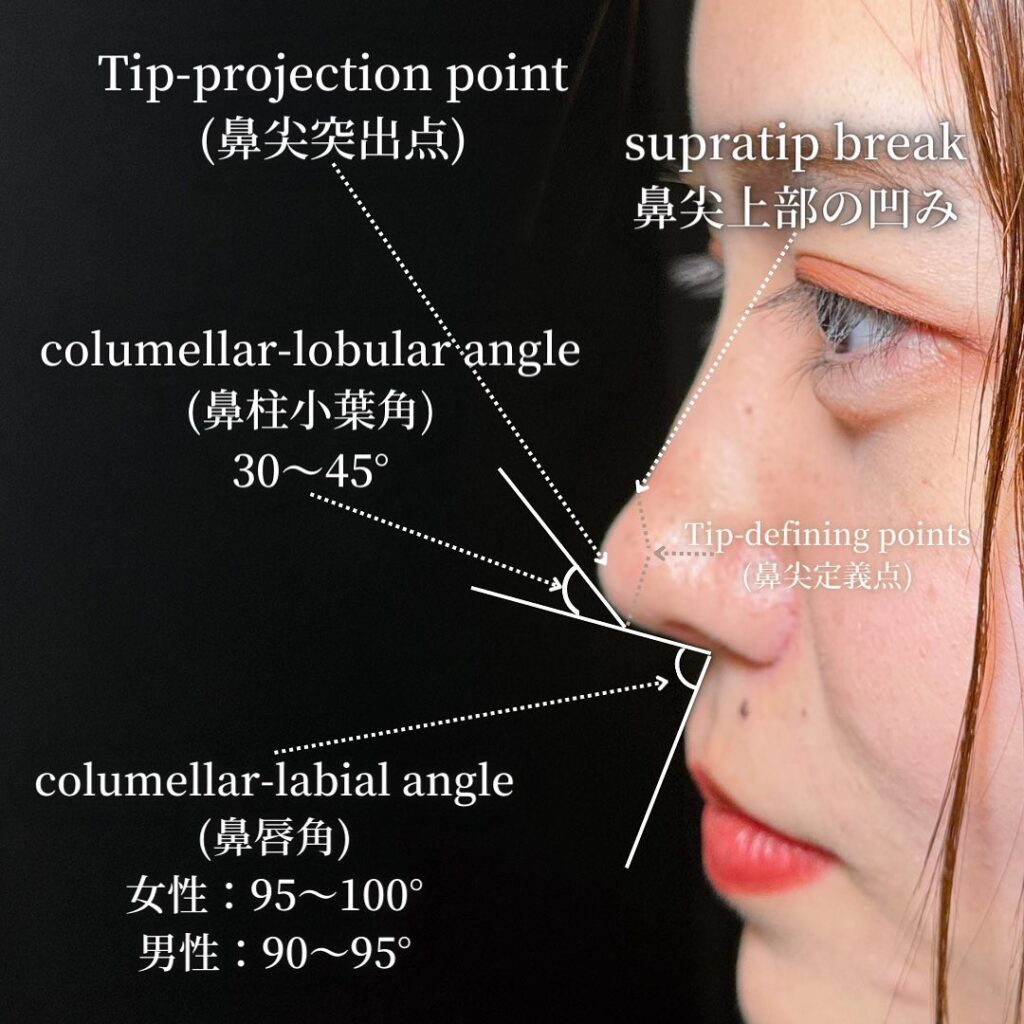鼻中隔延長と鼻尖形成と軟骨移植とプロテーゼと他院修正の症例写真 (3)