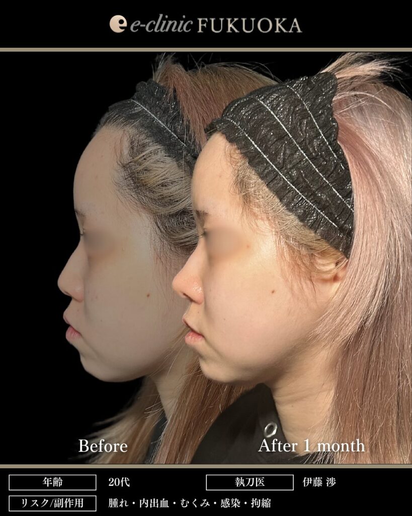 鼻尖形成と軟骨移植と小鼻縮小の症例写真 (17)