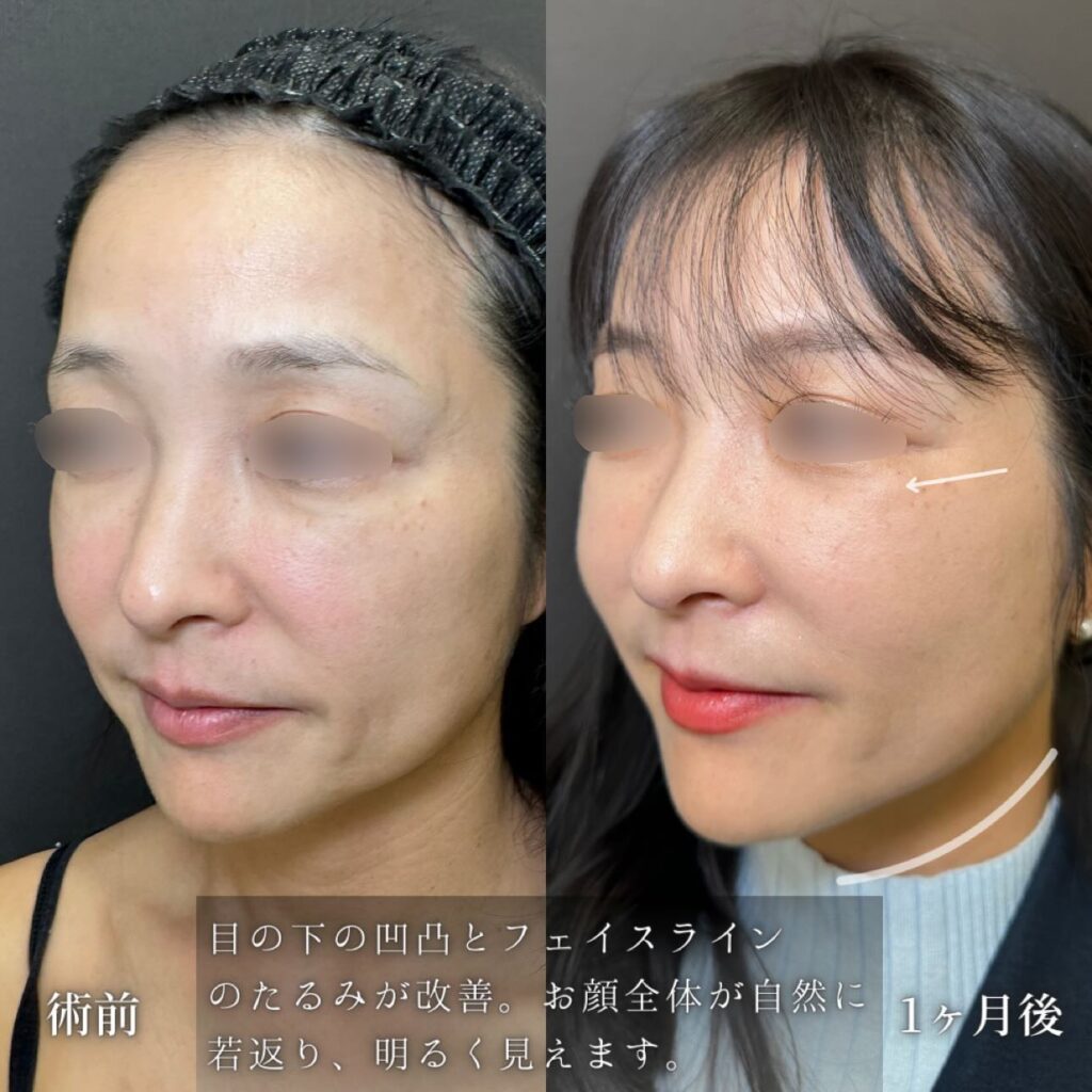 ハイブリットフェイスリフトと裏ハムラ法の症例写真 (3)