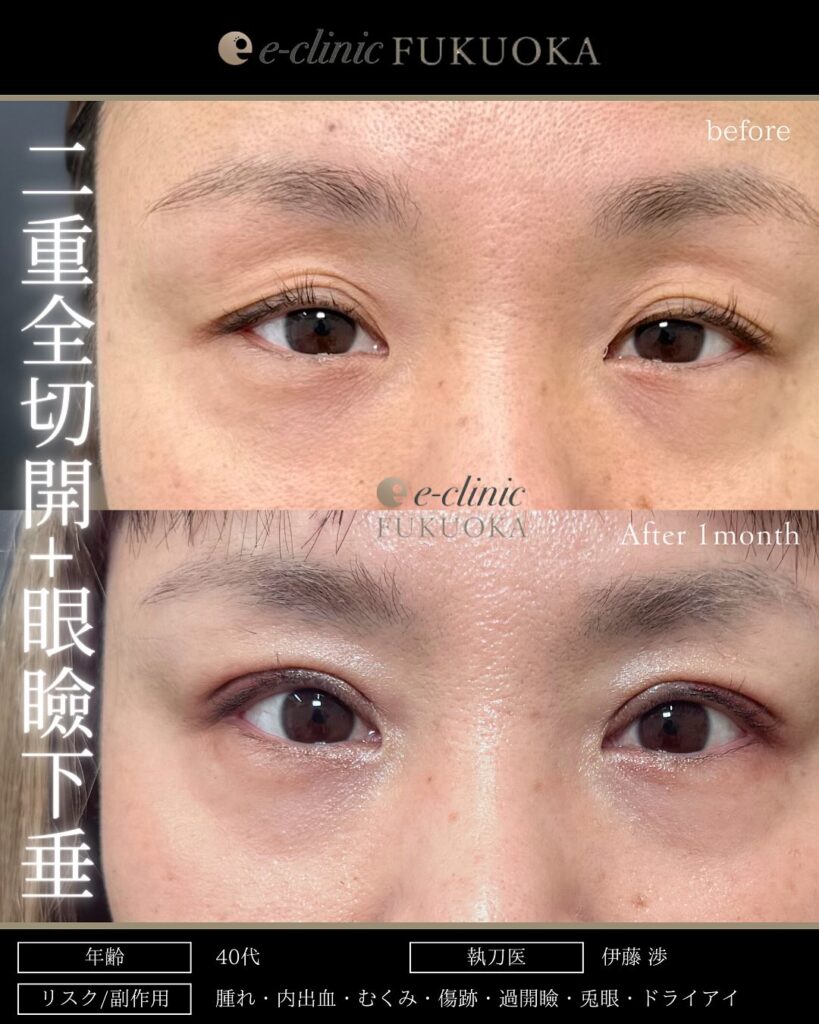 全切開と眼瞼下垂症例写真 (1)