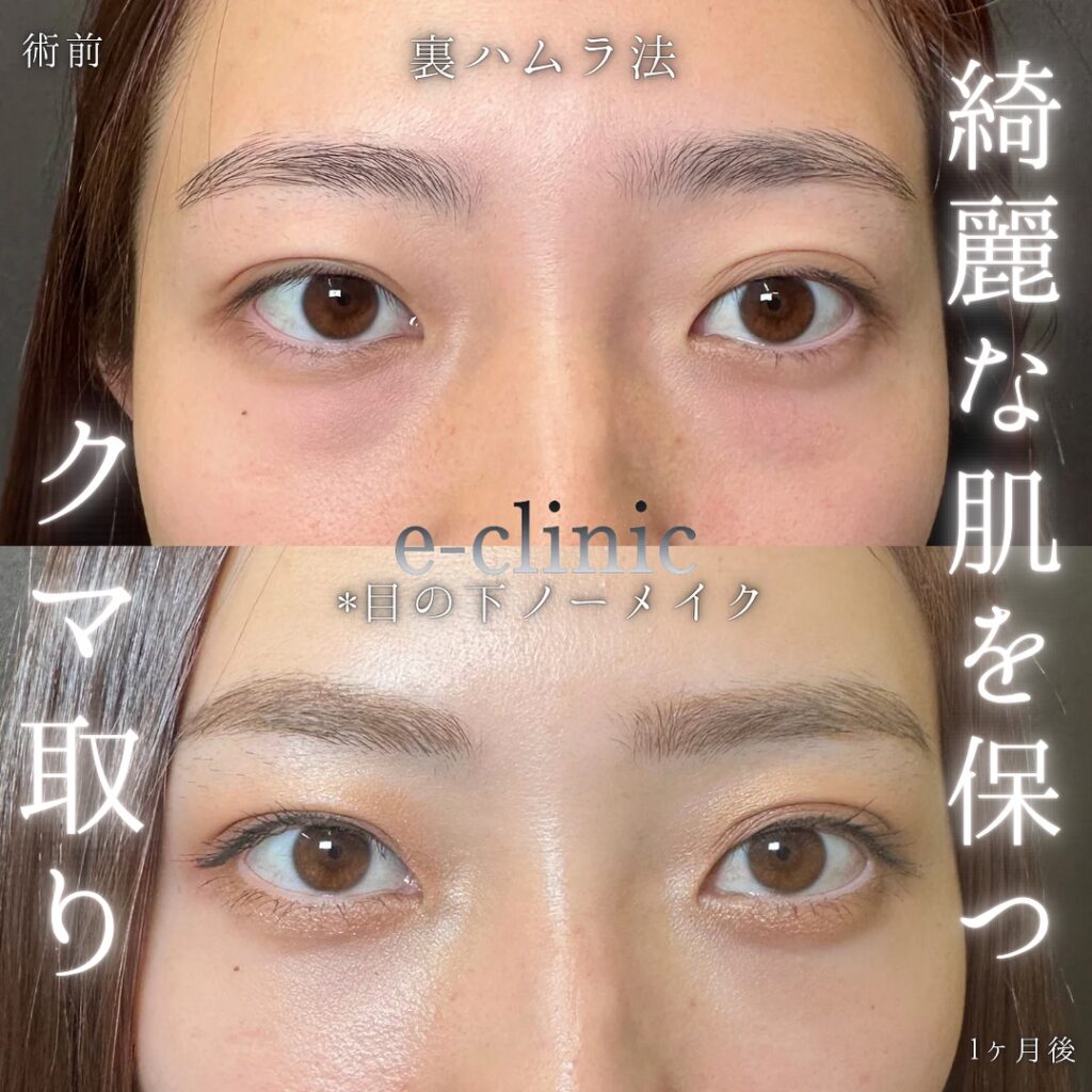 裏ハムラ法の症例写真 (59)