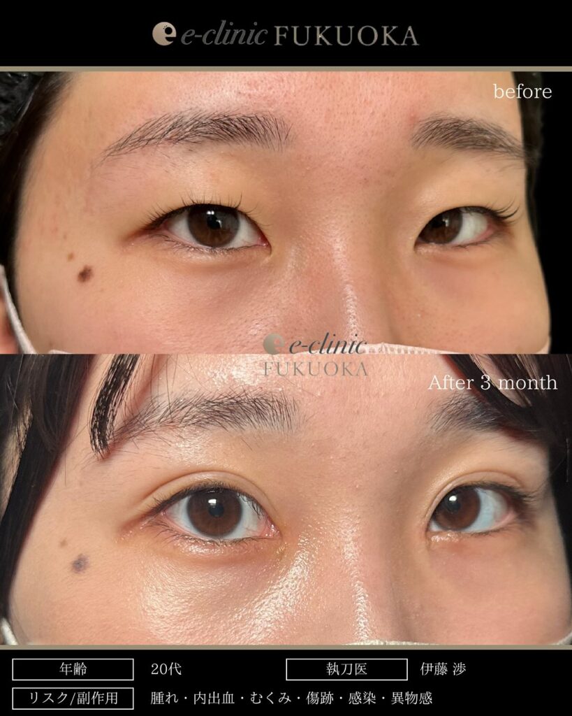 埋没法と目頭切開の症例写真 (7)