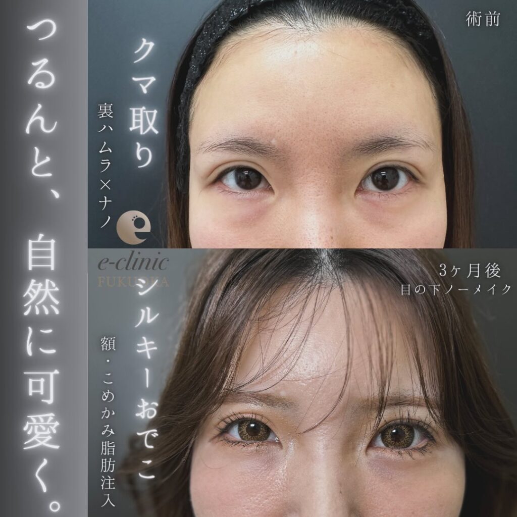 裏ハムラ方と脂肪注入の症例写真 (1)