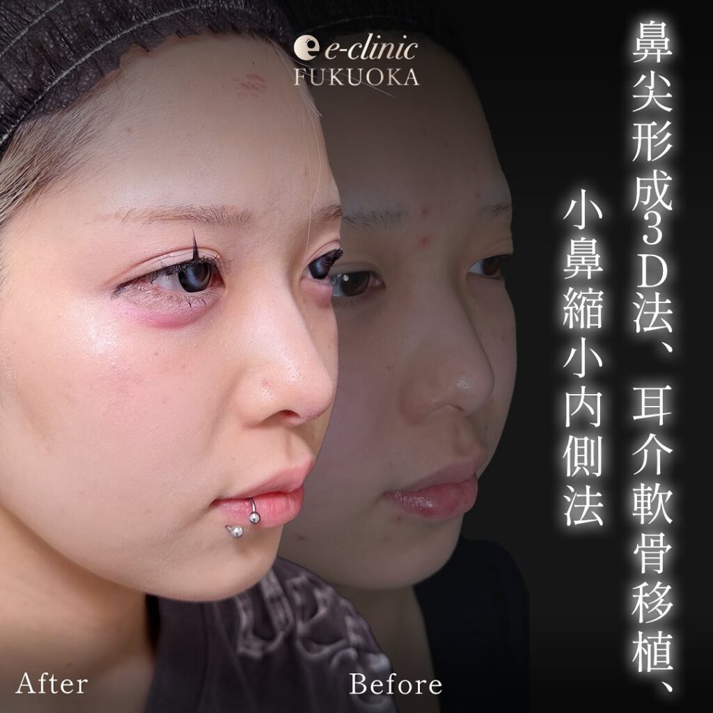 鼻尖形成と軟骨意欲と小鼻縮小の症例写真 (1)