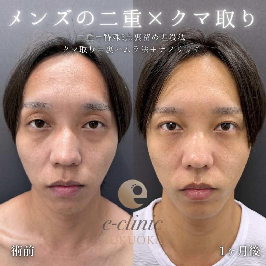 埋没法と裏ハムラ法と脂肪注入の症例写真 (1)