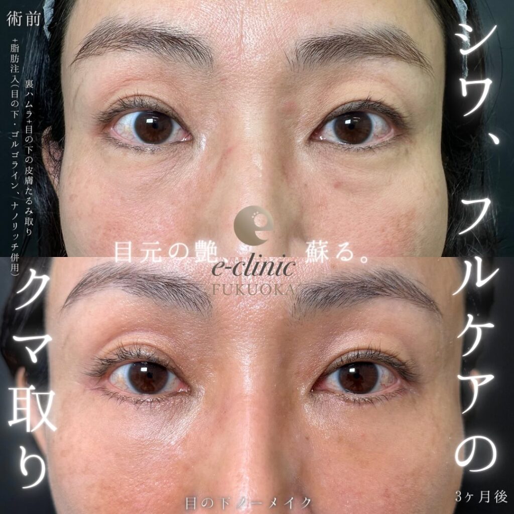 裏ハムラ法と脂肪注入の症例写真 (16)