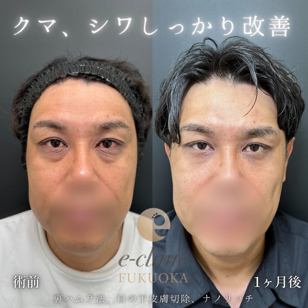 裏ハムラ法と目の下の脂肪注入の症例写真 (4)