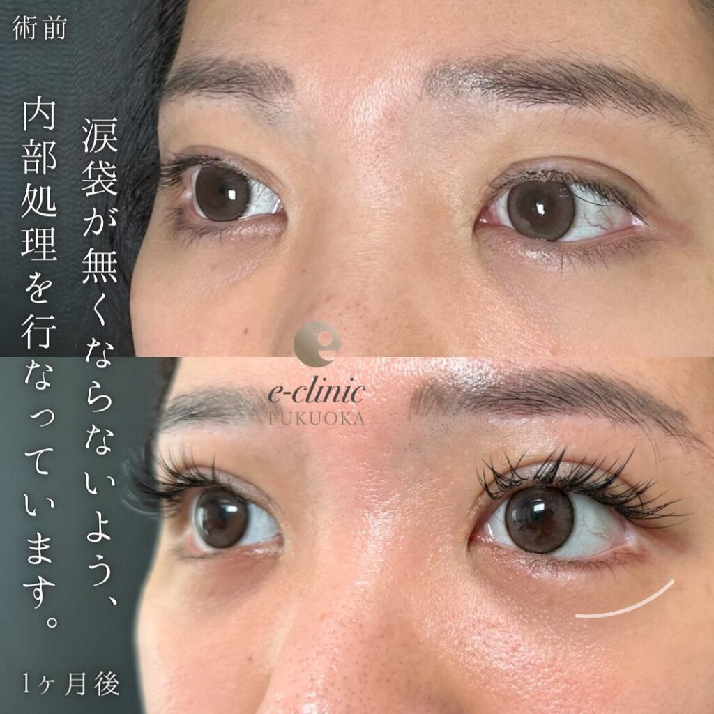 タレ目形成の症例写真 (7)