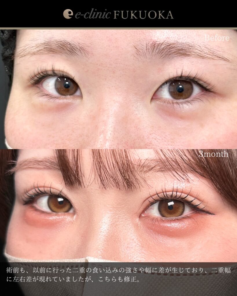 埋没法と目頭切開の症例写真 (14)